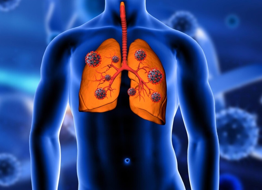Рак легких