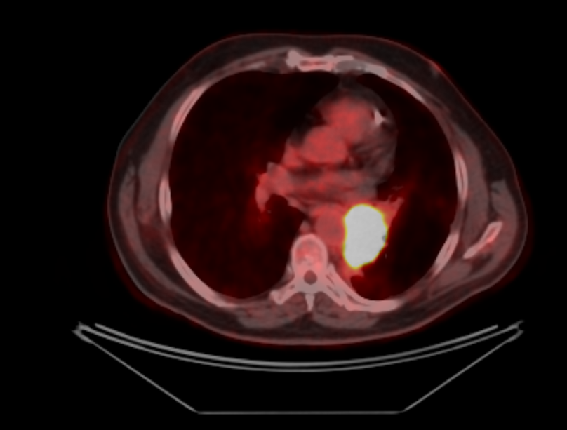 Курса дистанционной лучевой терапии