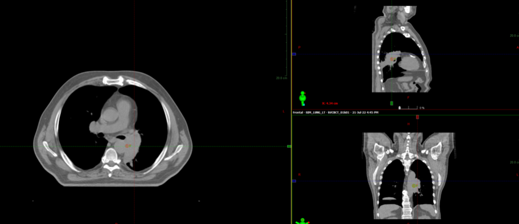 Курса дистанционной лучевой терапии