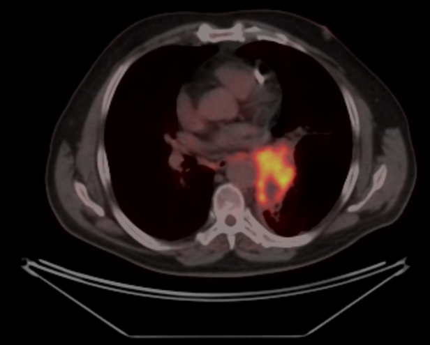 Курса дистанционной лучевой терапии