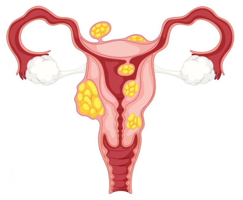 Рак вульвы и половых губ