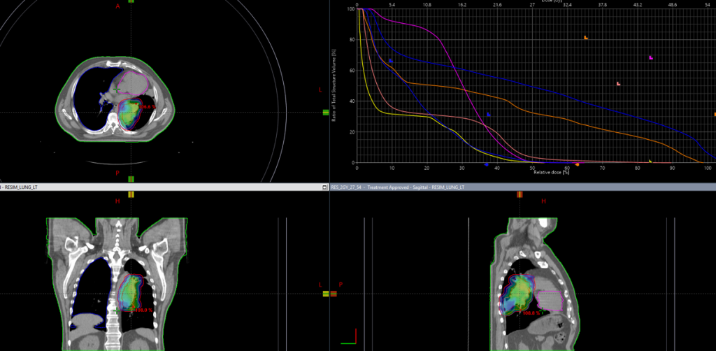 Курса дистанционной лучевой терапии