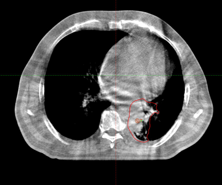 Курса дистанционной лучевой терапии