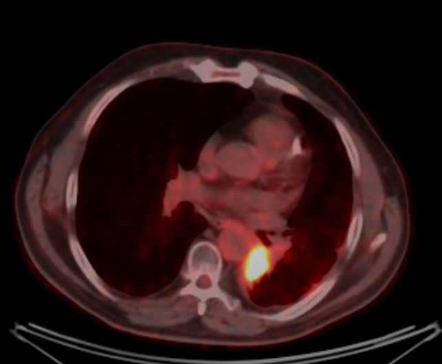 Курса дистанционной лучевой терапии