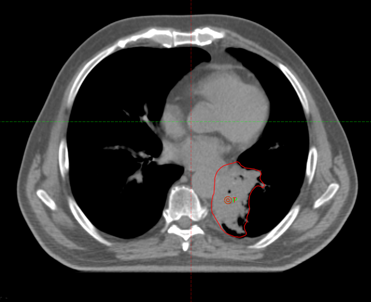 Курса дистанционной лучевой терапии
