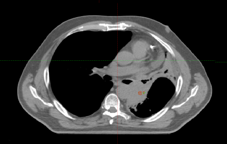 Курса дистанционной лучевой терапии
