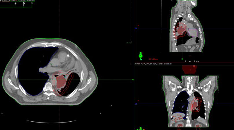 Курса дистанционной лучевой терапии