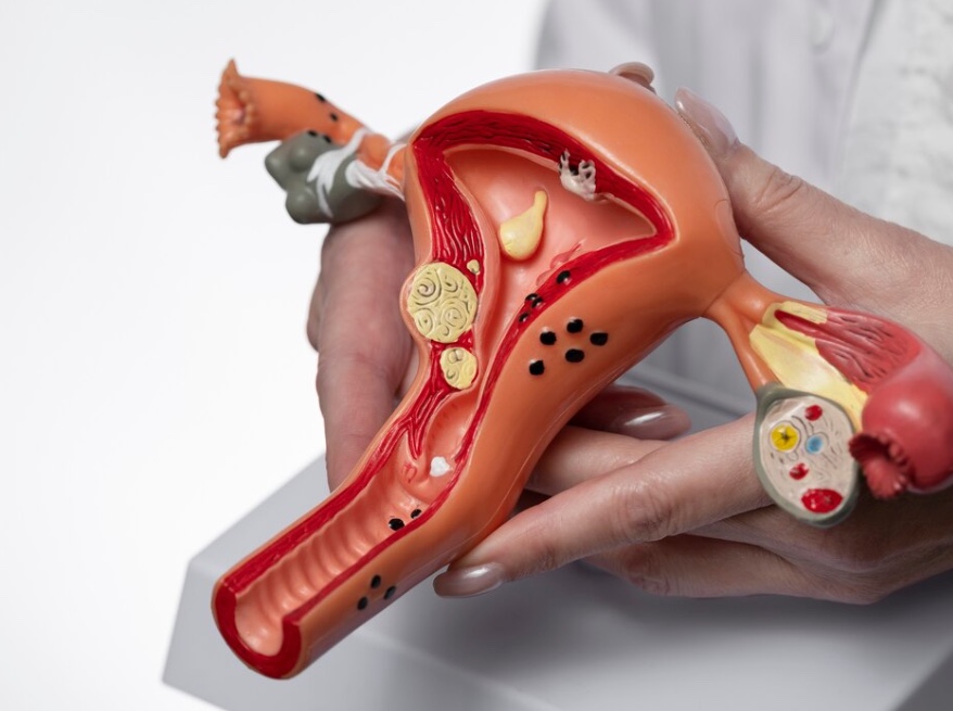 Рак яичников