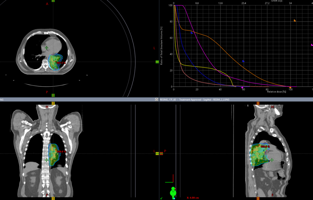 Курса дистанционной лучевой терапии