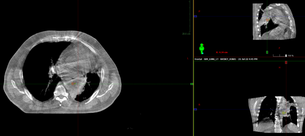 Курса дистанционной лучевой терапии