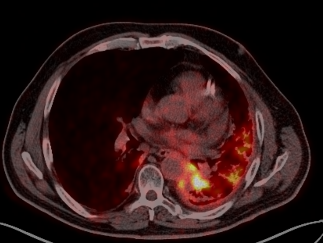 Курса дистанционной лучевой терапии